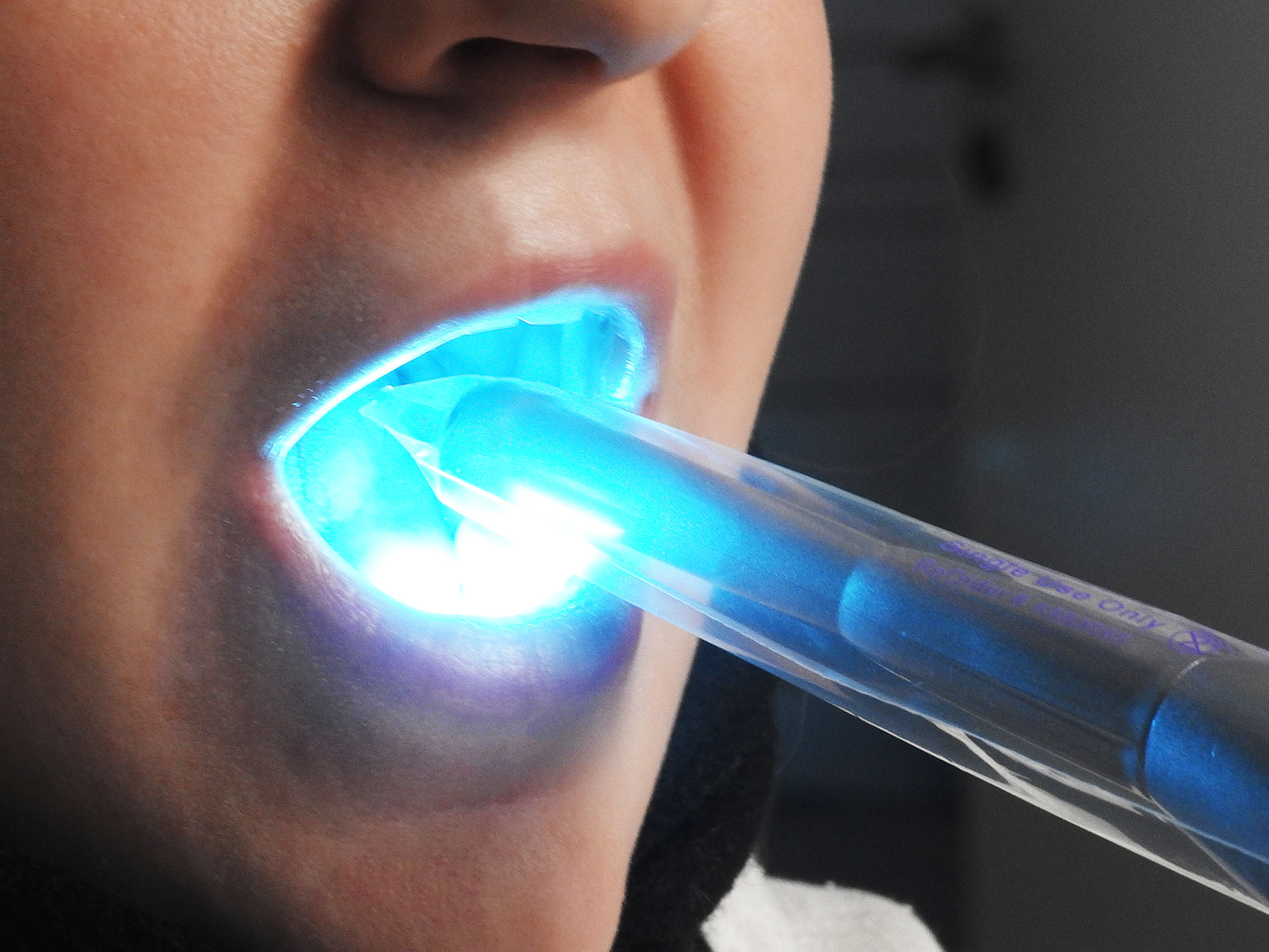 Zahnfüllung härten mit UV-Licht
